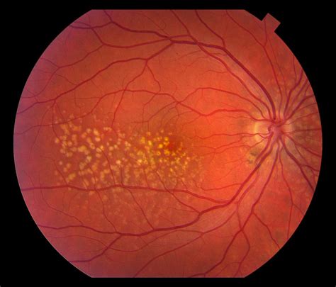 Macular degeneration